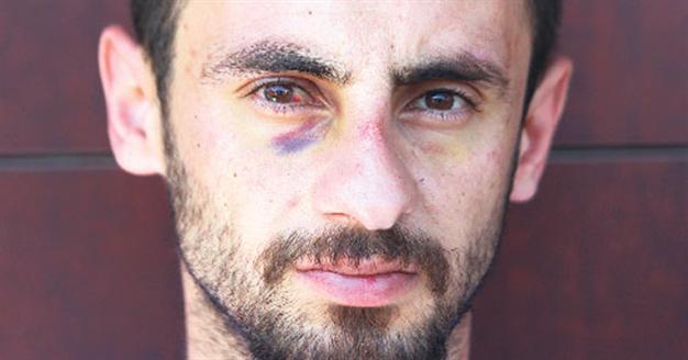 Man suffers brain hemorrhage after beating by Turkish police