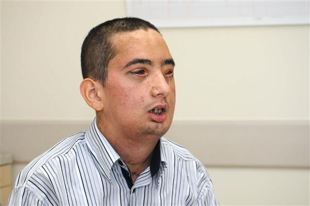 Fourth face transplant patient sees new face