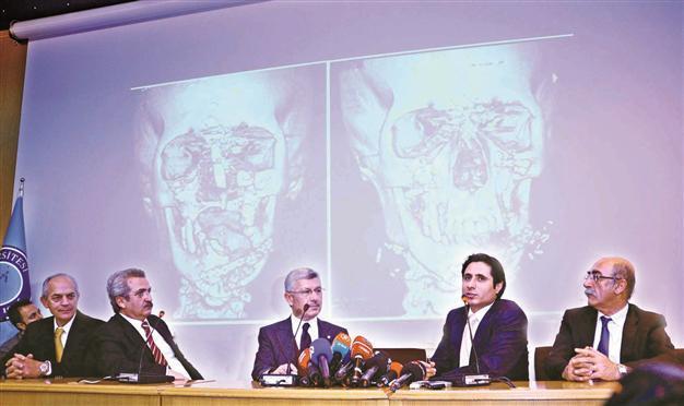 Health Ministry cautious on new face transplants