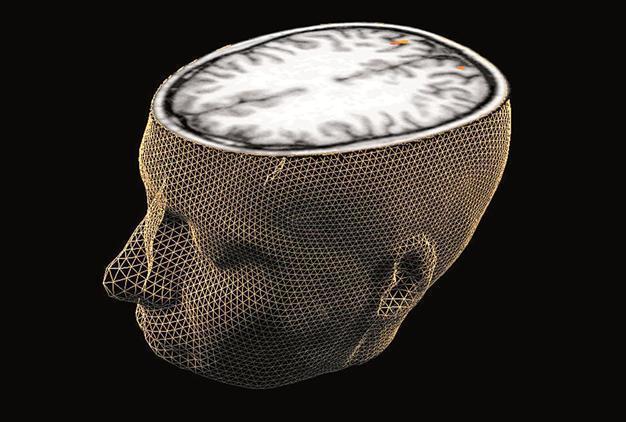 Injuries to brain may bring suicidal thoughts