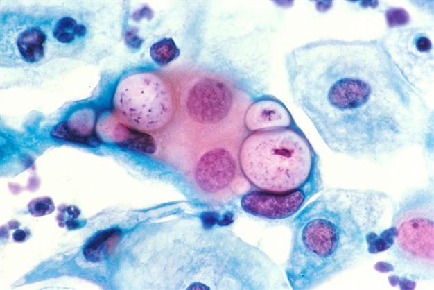 Pap smear: Cervical screening remains taboo in Turkey