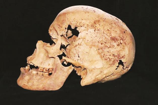 Oldest evidence of breast cancer found