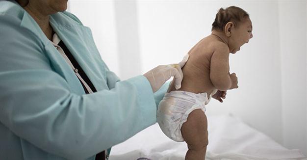 US health officials confirm Zika cause of severe birth defects