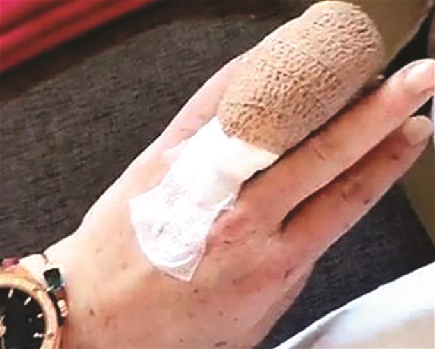 Lindsay Lohan’s finger partially severed in accident in Turkey’s south