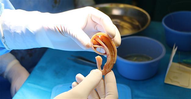 Patient in southern Turkey given new ears created from his mother’s rib cartilage