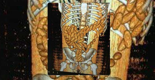 Half kilogram of cannabis found in Moroccan man’s digestive system in Istanbul