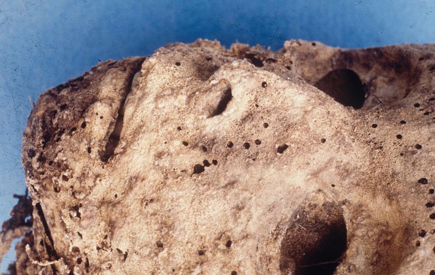 Child mummy in Italy had hepatitis, not smallpox