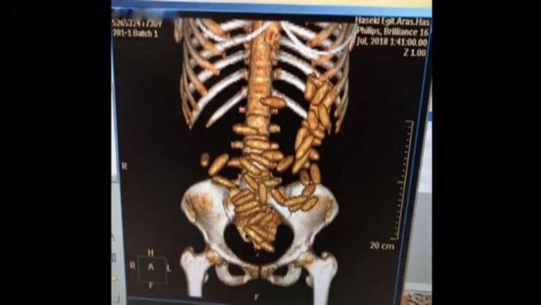 Brazilian woman caught in Istanbul airport with 51 cocaine capsules in her stomach