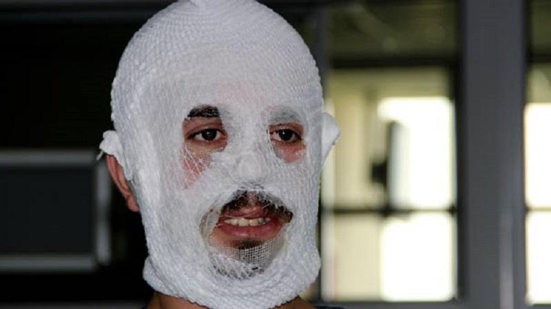 Moisturizer ‘burns’ Turkish man’s face