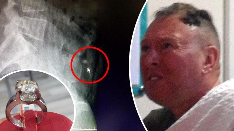 Irish man hospitalized in Turkey after swallowing stolen ring