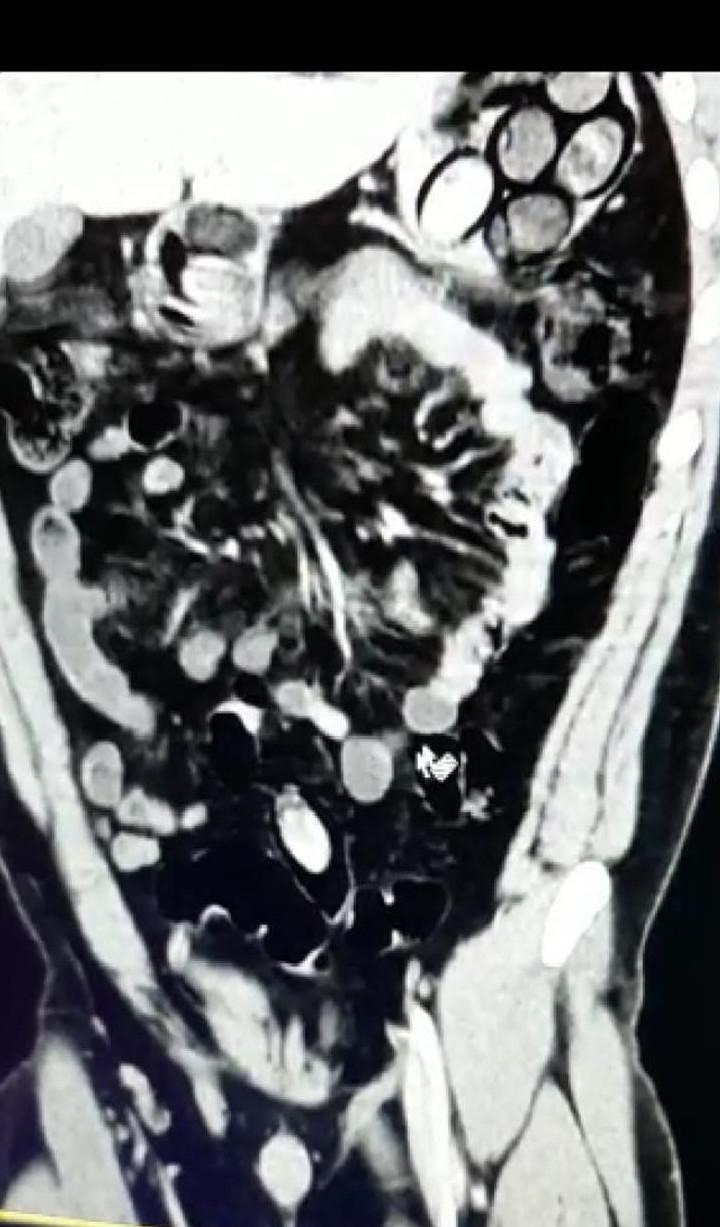 Police detain man carrying drug pills in stomach