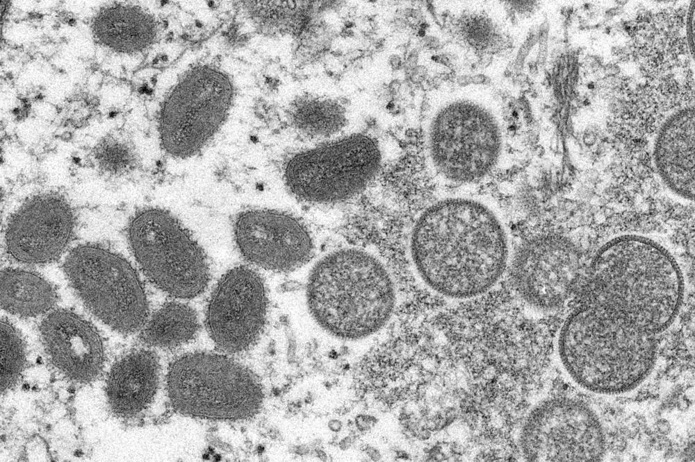 Tests negative, no monkeypox cases in Turkey: Minister