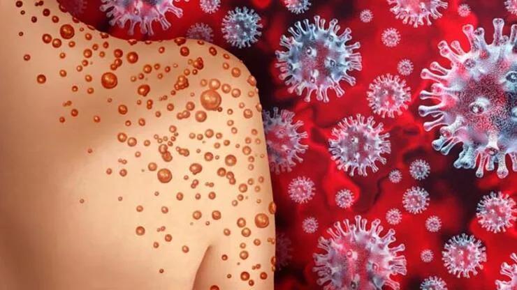 First monkeypox case detected in Türkiye: Minister