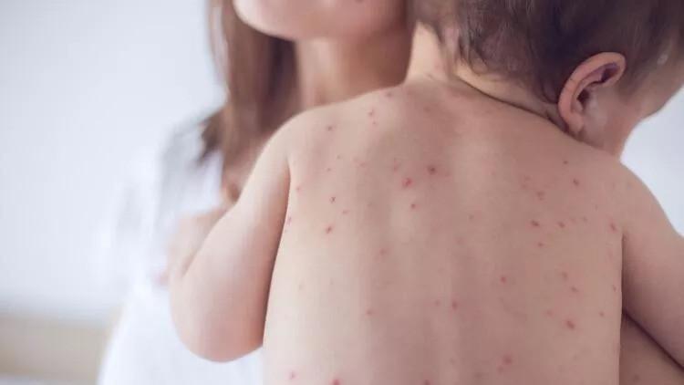 Anti-vaccination behind increase in measles cases, says expert
