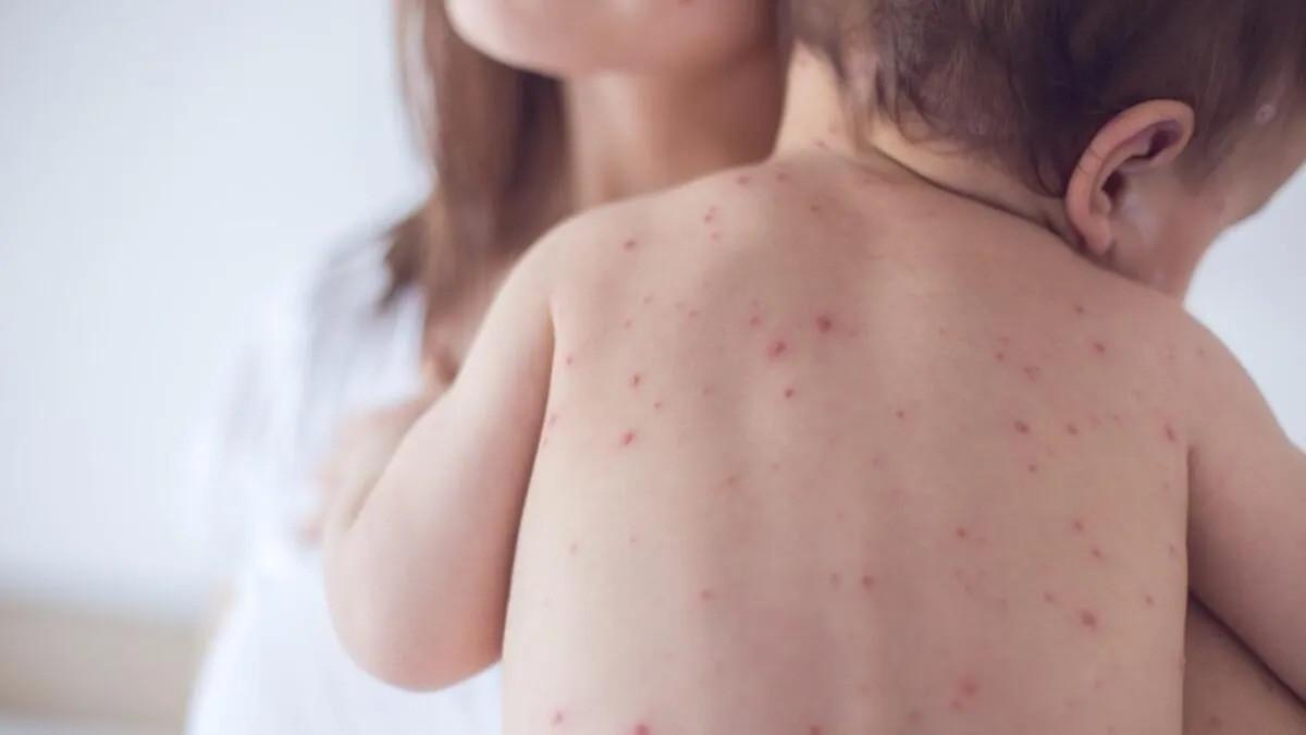 Minister denies allegations of measles-related deaths