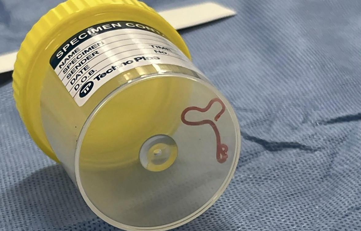 Live worm found in womans brain