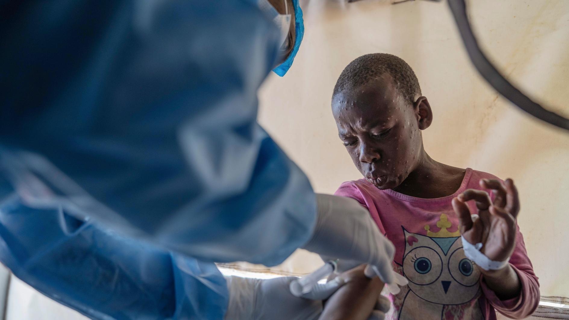 Mpox cases rise in DR Congo as country awaits vaccines