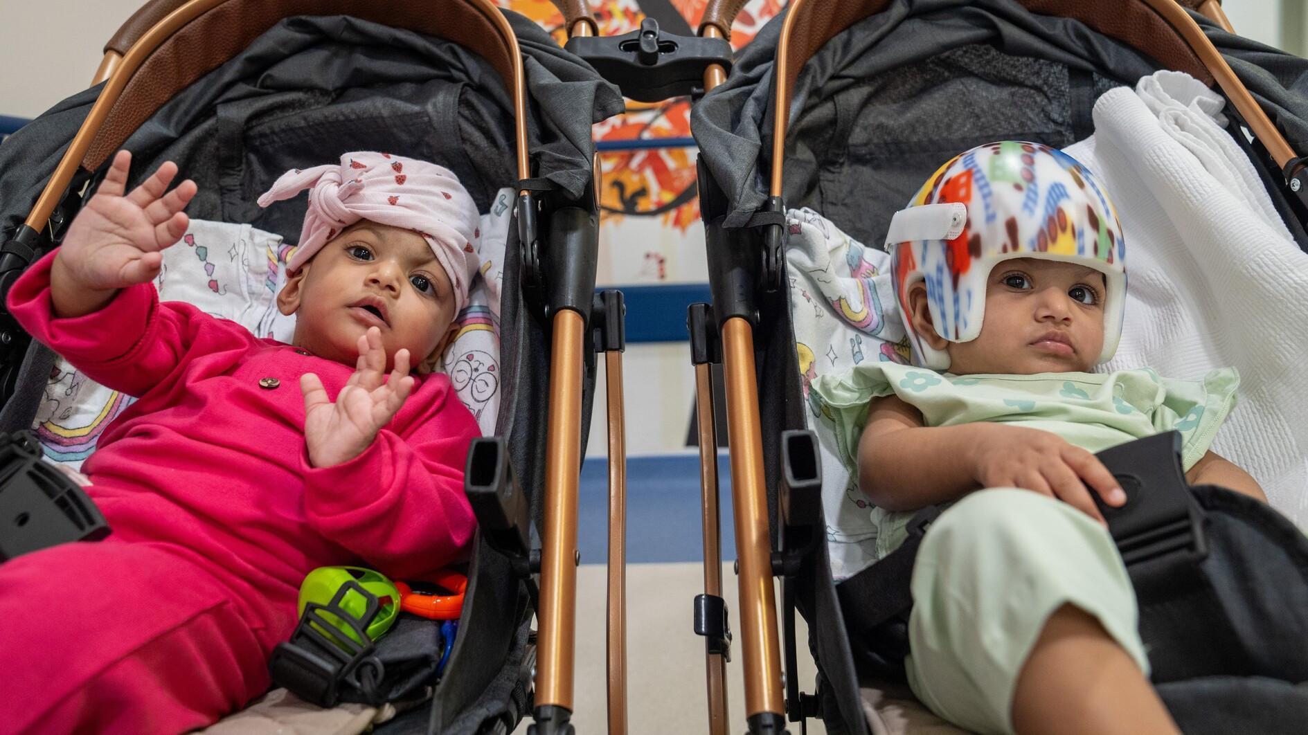 Pakistani conjoined twins separated in 14-hour operations in Türkiye