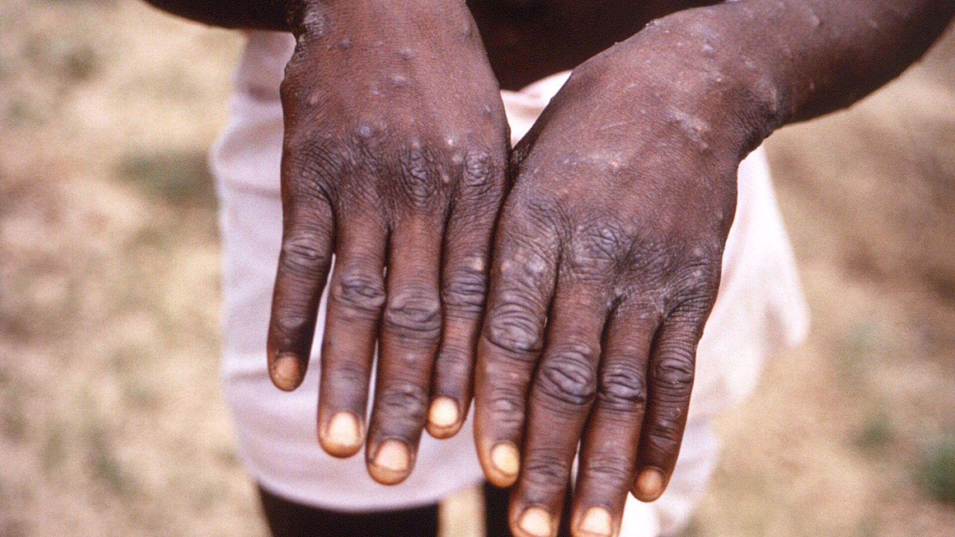 Gambia declares mpox outbreak
