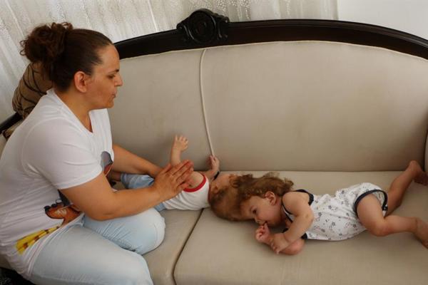 Conjoined Turkish twins celebrate first birthday