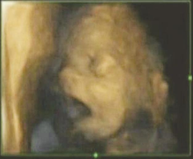 Scans show fetuses yawn in the womb