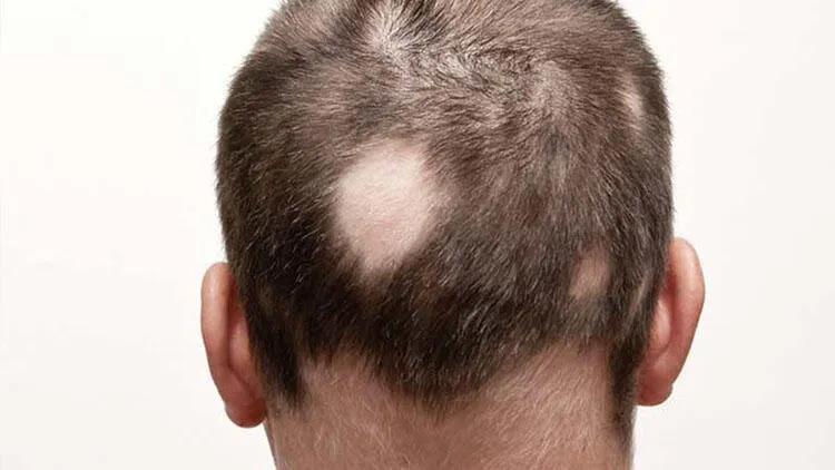 Işın Karaca'nın sağlık durumu nasıl, hastalığı ne? Alopeci Universal ...