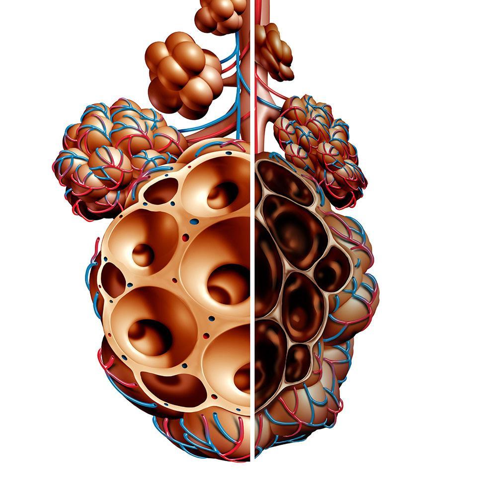 Sigara kullan�m� KOAH riskini y�zde 80 art�r�yor