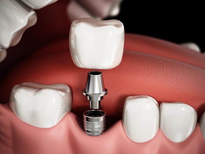 Metal dolgu ve implantı olanlar ondan uzak dursun