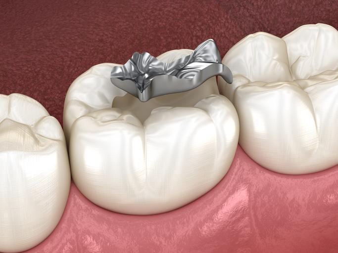 Metal dolgu ve implantı olanlar ondan uzak dursun