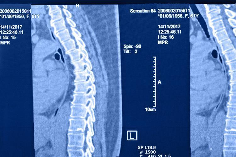 Omurgam parçalanıyor gibiydi Hayatı boyunca hissettiği en kötü ağrıdan bile daha kötüsüydü... Sebebi doktorları bile şaşırttı