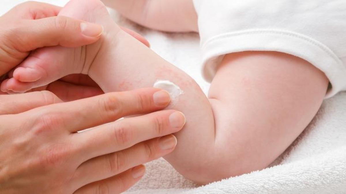 Alerjik bebek ciltleri için 5 önlem
