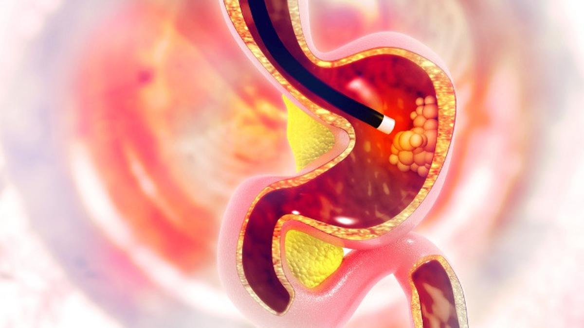 Endoskopi nedir, nasıl yapılır? Endoskopi öncesi hazırlık ve endoskopi sonrası beslenme bilgileri