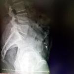 Irish man hospitalized in Turkey after swallowing stolen ring