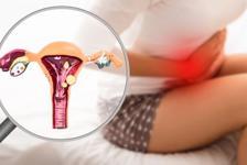 Endometriozis Hakkında Merak Edilen Her Şey