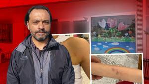 Özel anaokulunda skandal Çocuğunun vücudunu gören baba soluğu savcılıkta aldı