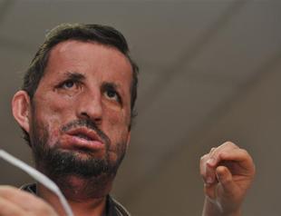 Turkeys first face transplant patient hopes for fast recovery