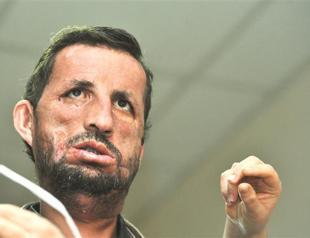 Face transplant patient Acar meets reporters