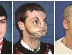 Images from full face transplant revealed