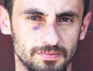 Man suffers brain hemorrhage after beating by Turkish police