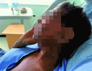 Turkish girl in Germany victim of nitric acid attack