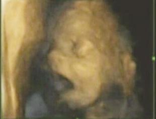 Scans show fetuses yawn in the womb