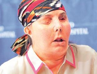 Facial transplant shown to the world