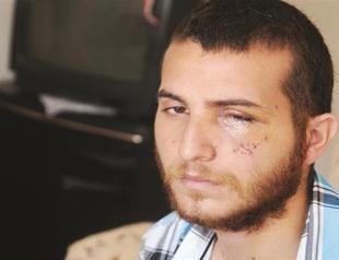 Young protester loses eye from rubber bullet, mother wants justice