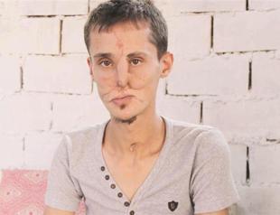 Seventh face transplant patient has ‘new life’