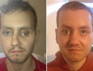Build me a face in 3D: British mans life transformed