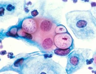 Pap smear: Cervical screening remains taboo in Turkey