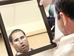 Turkey’s sixth face transplant removed due to organ failure