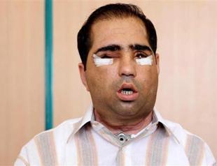 Turkey’s sixth face transplant patient dies