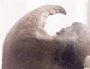 Ancient brain surgery recreated