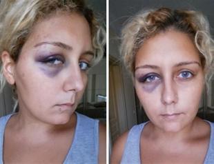 Turkish woman posts ex-boyfriend’s assaults on blog for help